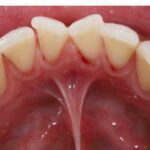 7 Consejos Geniales para Eliminar las Manchas de Sarro