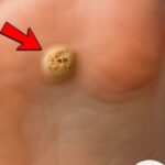 🧄 Elimina las verrugas plantares de forma natural con estos remedios con ajo