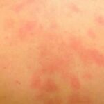 ¿Alergia al agua?…más