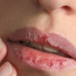 Labios Agrietados: Entendiendo el Problema…más
