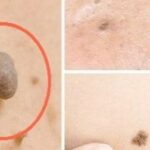 Remedios naturales para eliminar verrugas, puntos negros y manchas de la edad