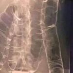 Colon Saturado: Cuando el Cuerpo Da la Alarma
