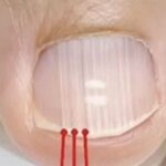 Si notas líneas en las uñas, a veces pueden indicar algo sobre tu salud.