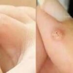 Tenga mucho cuidado: Si nota este crecimiento en la piel, podría tratarse de una afección grave.
