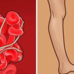 8 señales de que se puede estar formando un coágulo de sangre en tu cuerpo: cómo reconocerlos y qué hacer